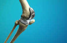 Joint Replacement Surgery Specialist in Betul