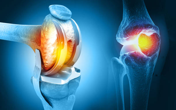 Joint Replacement Surgery Specialist in Chhatarpur