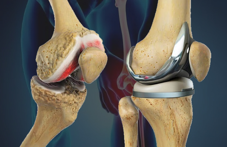 Joint Replacement Surgery Specialist in Chhindwara