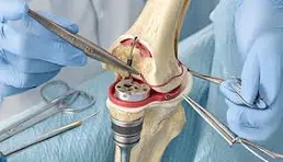 Joint Replacement Surgery Specialist in Katni