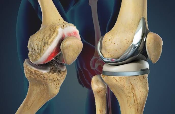 Joint Replacement Surgery Specialist in Rajgarh