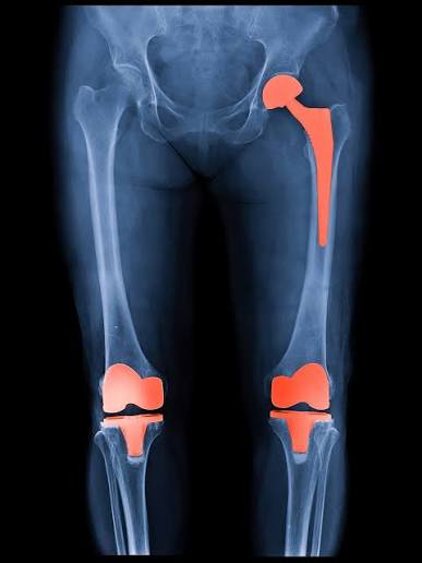 Joint Replacement Surgery Specialist in Vidisha