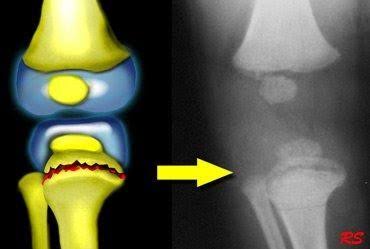 Orthopedic, Fracture & Accidental Hospital in Chhindwara