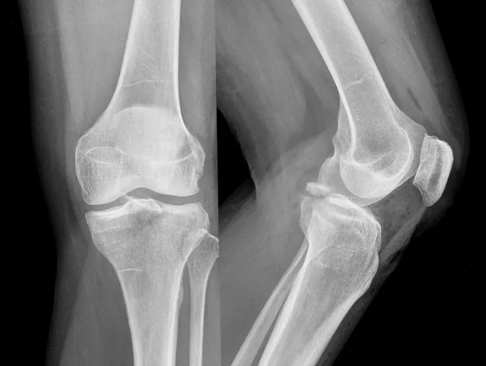 Orthopedic, Fracture & Accidental Hospital in Damoh