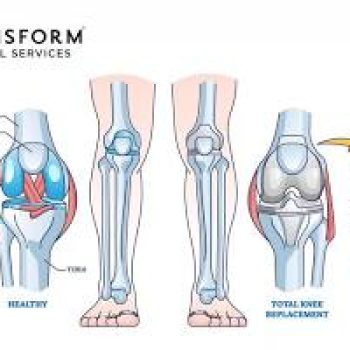 Knee Replacement Shivpuri